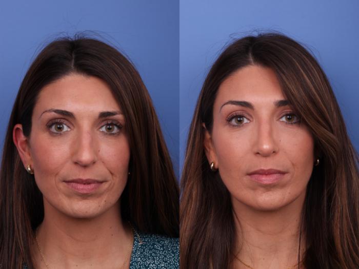 Rhinoplasty Before & After Photo | Scottsdale & Phoenix, AZ | Hobgood Facial Plastic Surgery: Todd Hobgood, MD