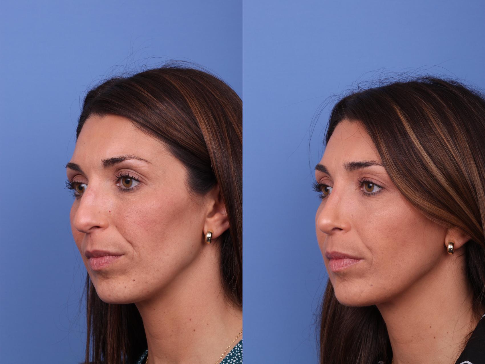 Before & After Rhinoplasty Case 595 Left Oblique View in Scottsdale, AZ