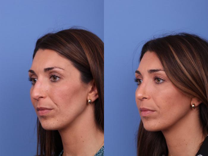 Rhinoplasty Before & After Photo | Scottsdale & Phoenix, AZ | Hobgood Facial Plastic Surgery: Todd Hobgood, MD