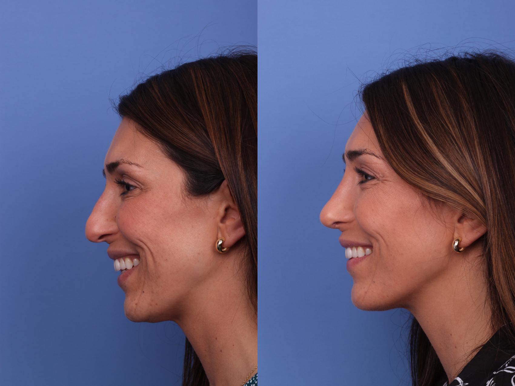 Before & After Rhinoplasty Case 595 Left Smile View in Scottsdale, AZ