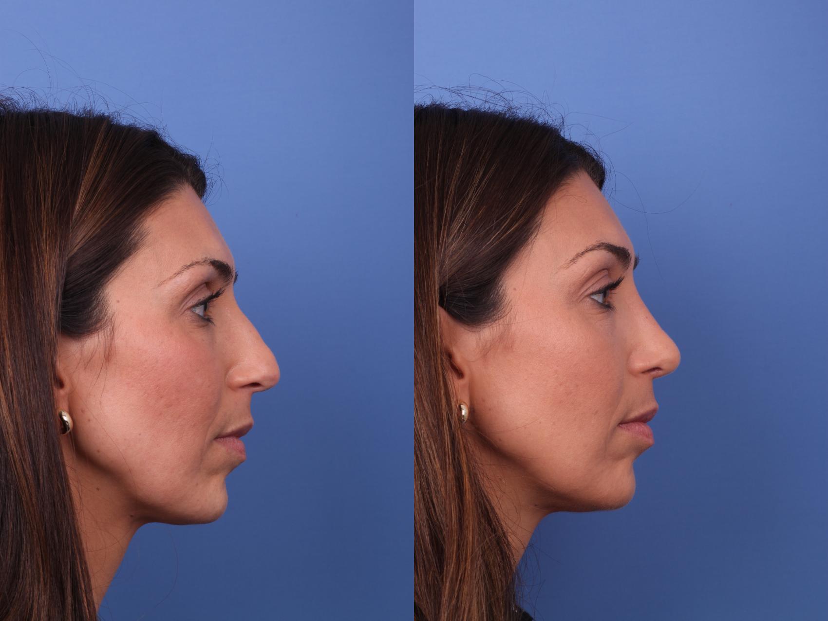 Before & After Rhinoplasty Case 595 Right Side View in Scottsdale, AZ