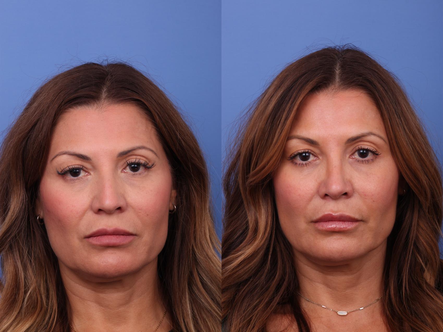 Before & After Rhinoplasty Case 596 Front View in Scottsdale, AZ