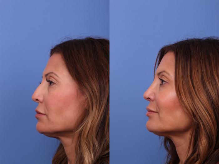 Rhinoplasty Before & After Photo | Scottsdale & Phoenix, AZ | Hobgood Facial Plastic Surgery: Todd Hobgood, MD