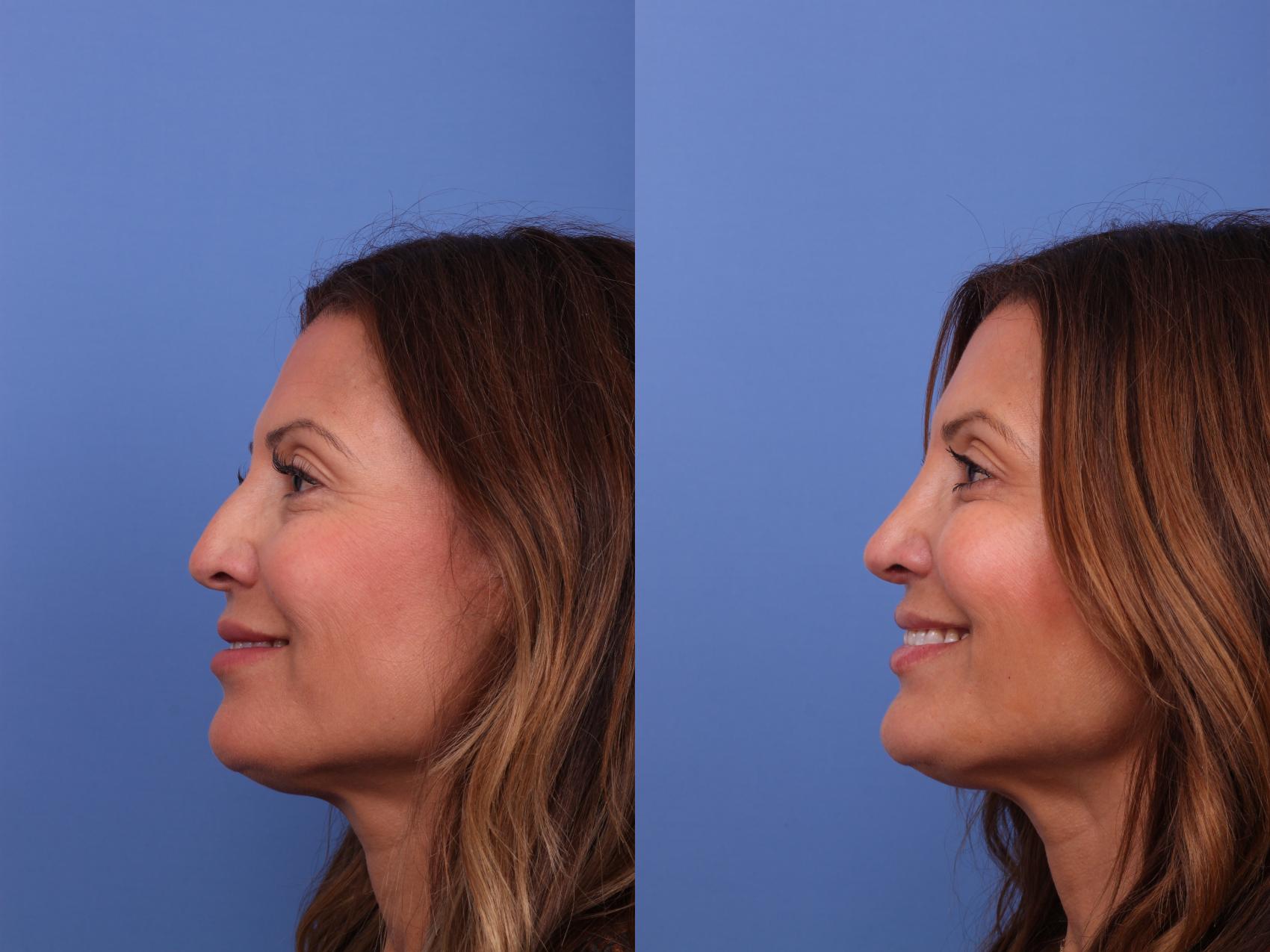 Before & After Rhinoplasty Case 596 Left Smile View in Scottsdale, AZ