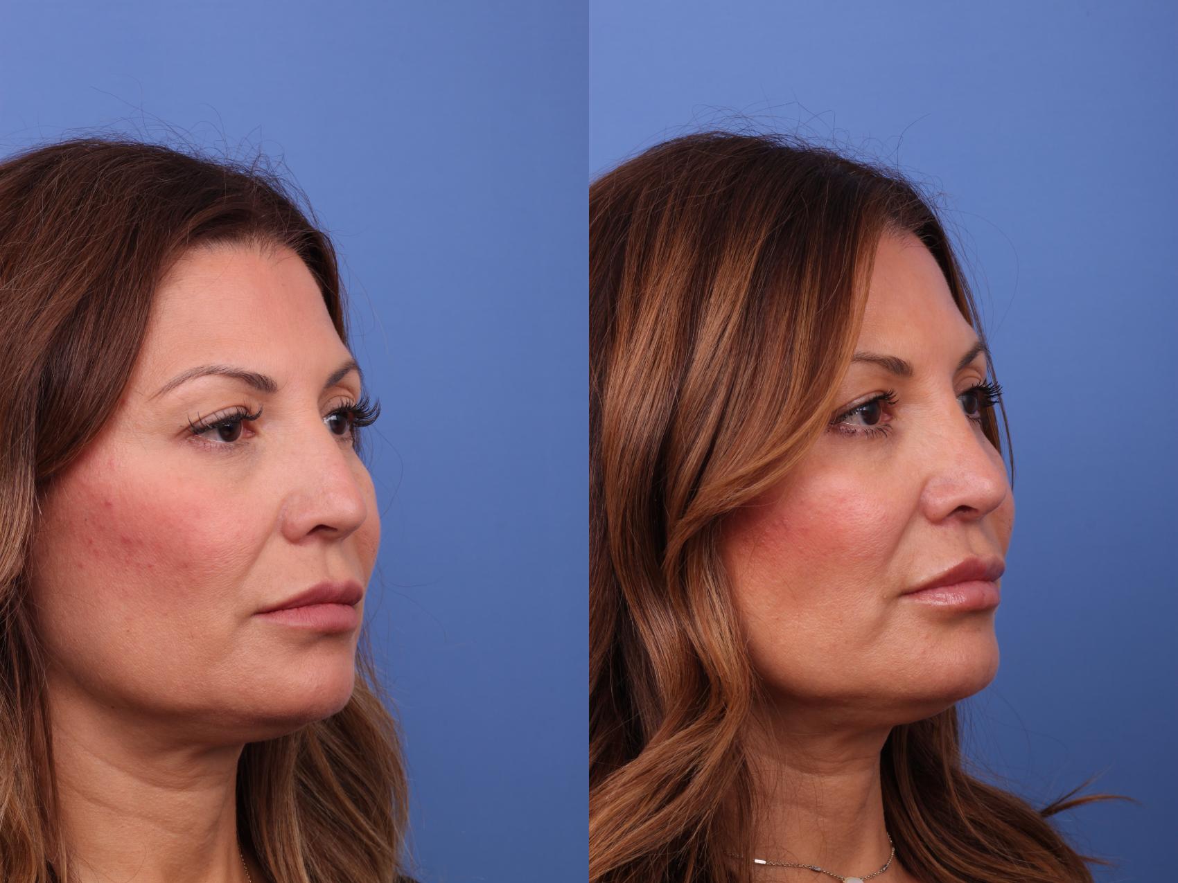Before & After Rhinoplasty Case 596 Right Oblique View in Scottsdale, AZ