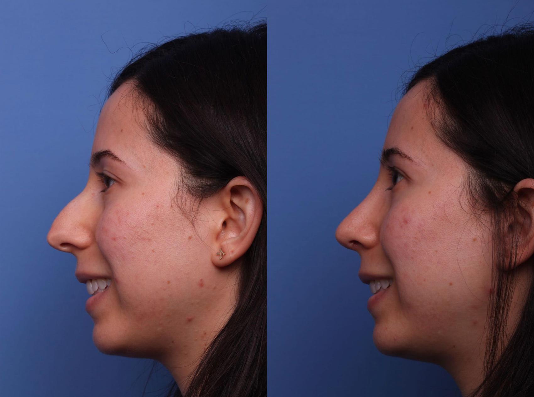 Before & After Rhinoplasty Case 6 View #2 View in Scottsdale, AZ