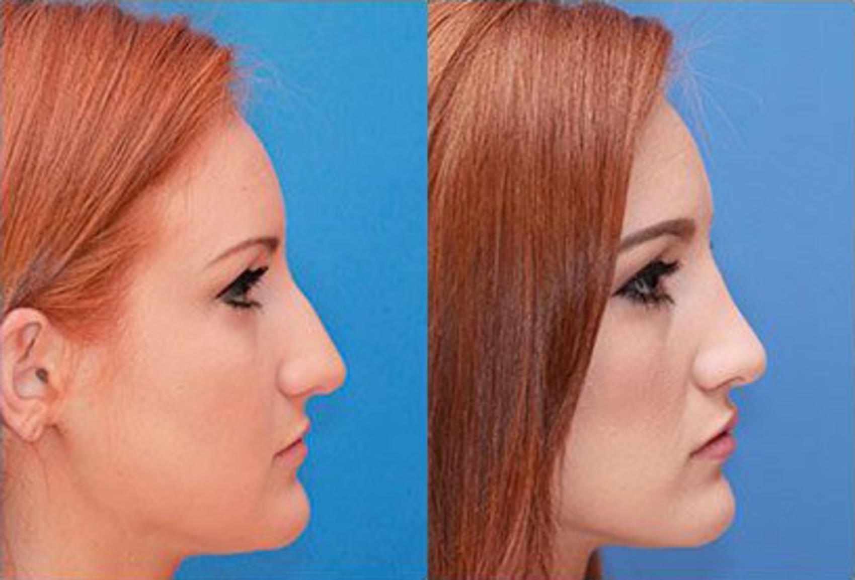Before & After Rhinoplasty Case 60 View #2 View in Scottsdale, AZ