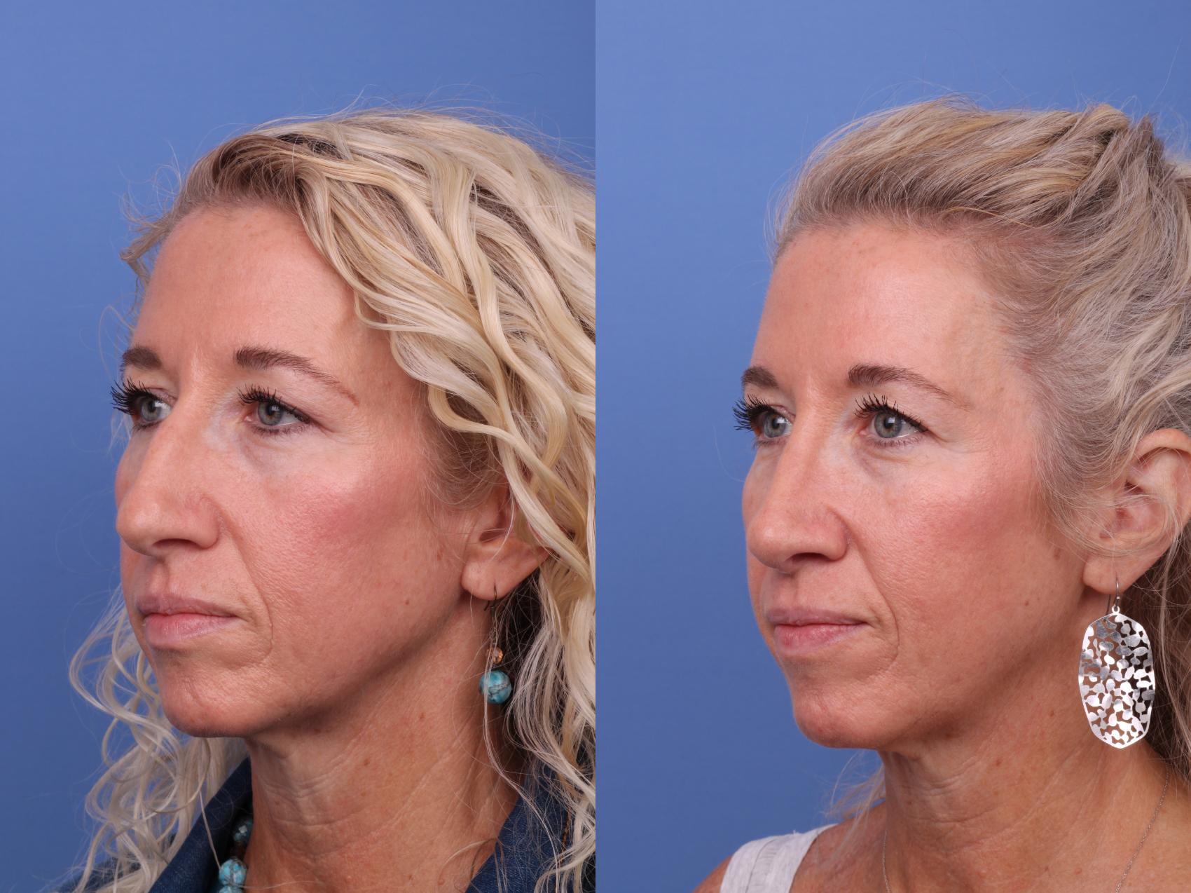 Before & After Rhinoplasty Case 601 Left Oblique View in Scottsdale, AZ