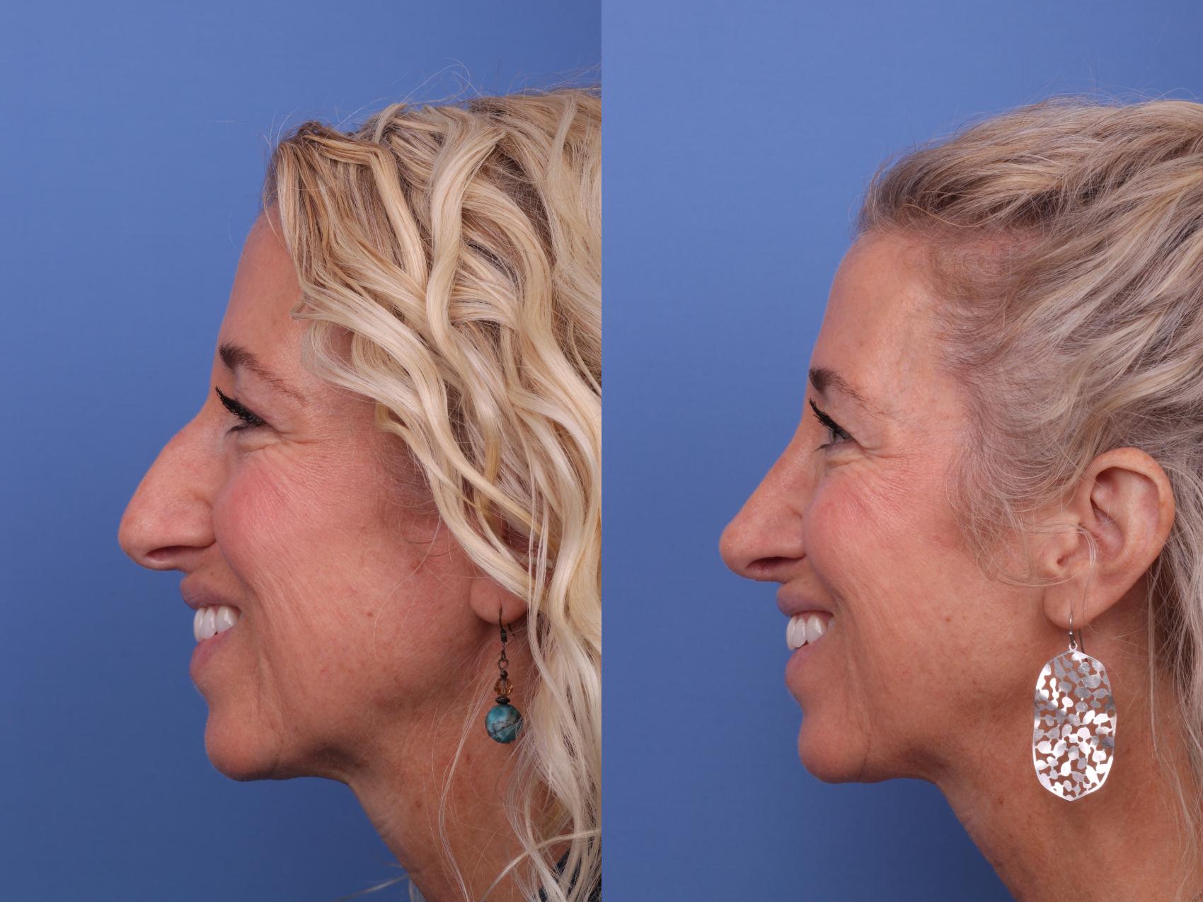 Before & After Rhinoplasty Case 601 Left Smile View in Scottsdale, AZ