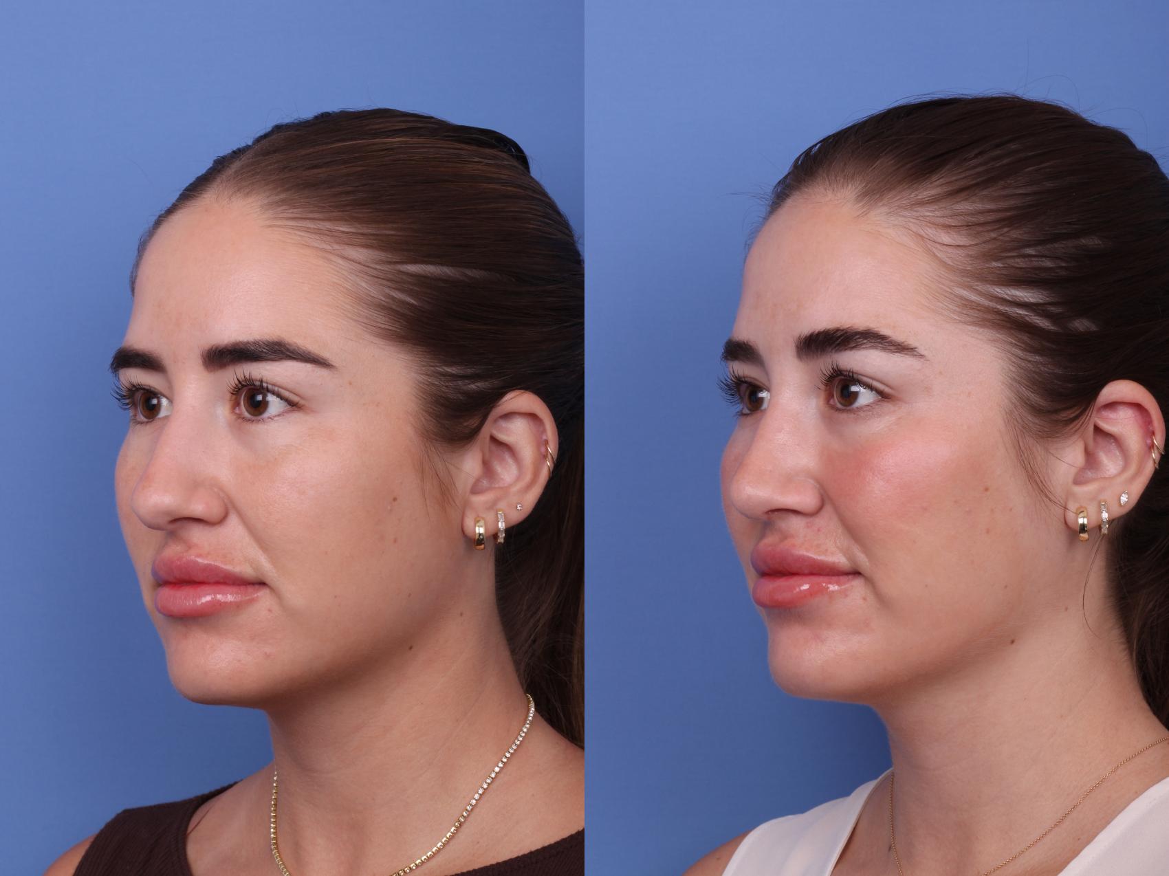 Before & After Rhinoplasty Case 602 Left Oblique View in Scottsdale, AZ
