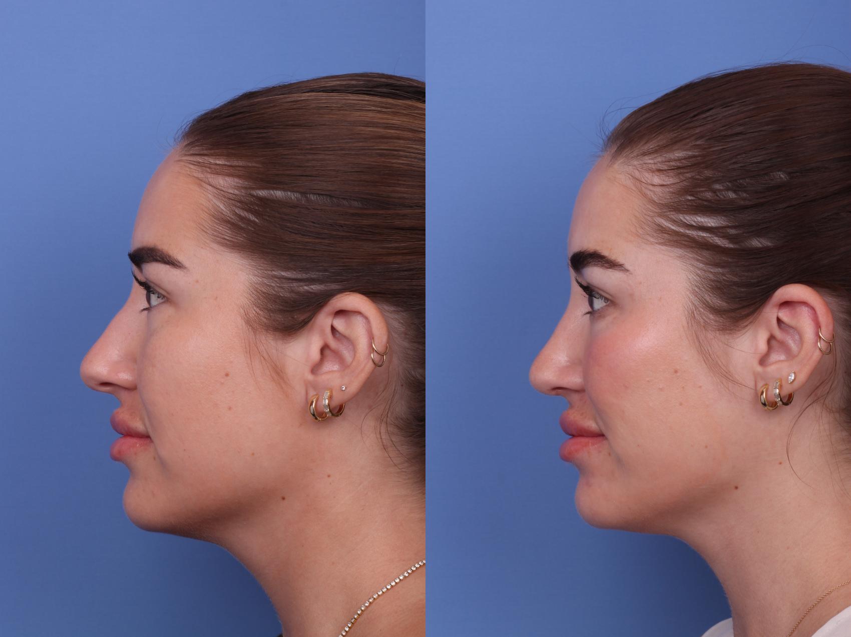 Before & After Rhinoplasty Case 602 Left Side View in Scottsdale, AZ