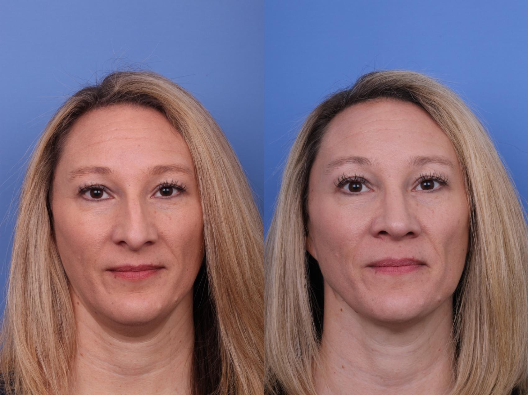 Before & After Rhinoplasty Case 605 Front View in Scottsdale, AZ