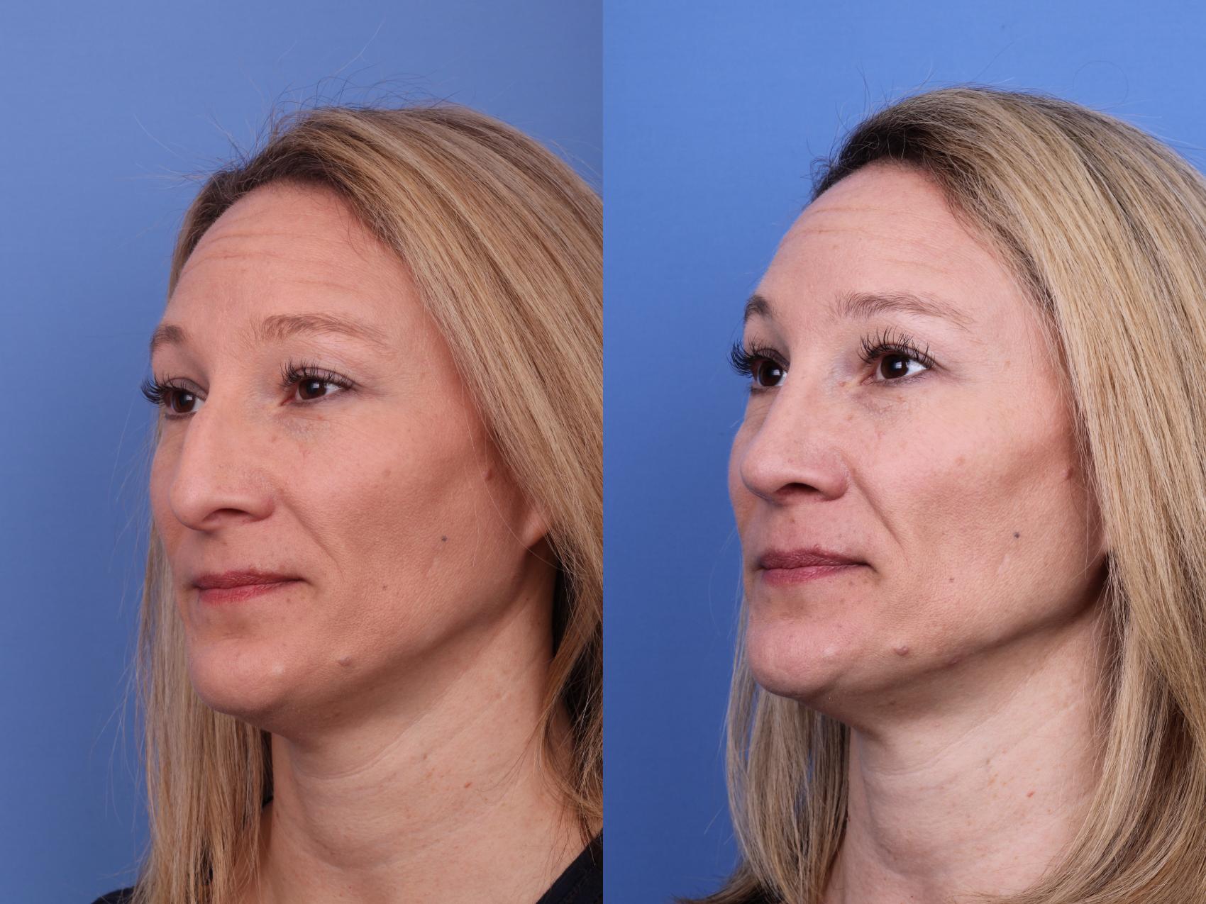 Before & After Rhinoplasty Case 605 Left Oblique View in Scottsdale, AZ