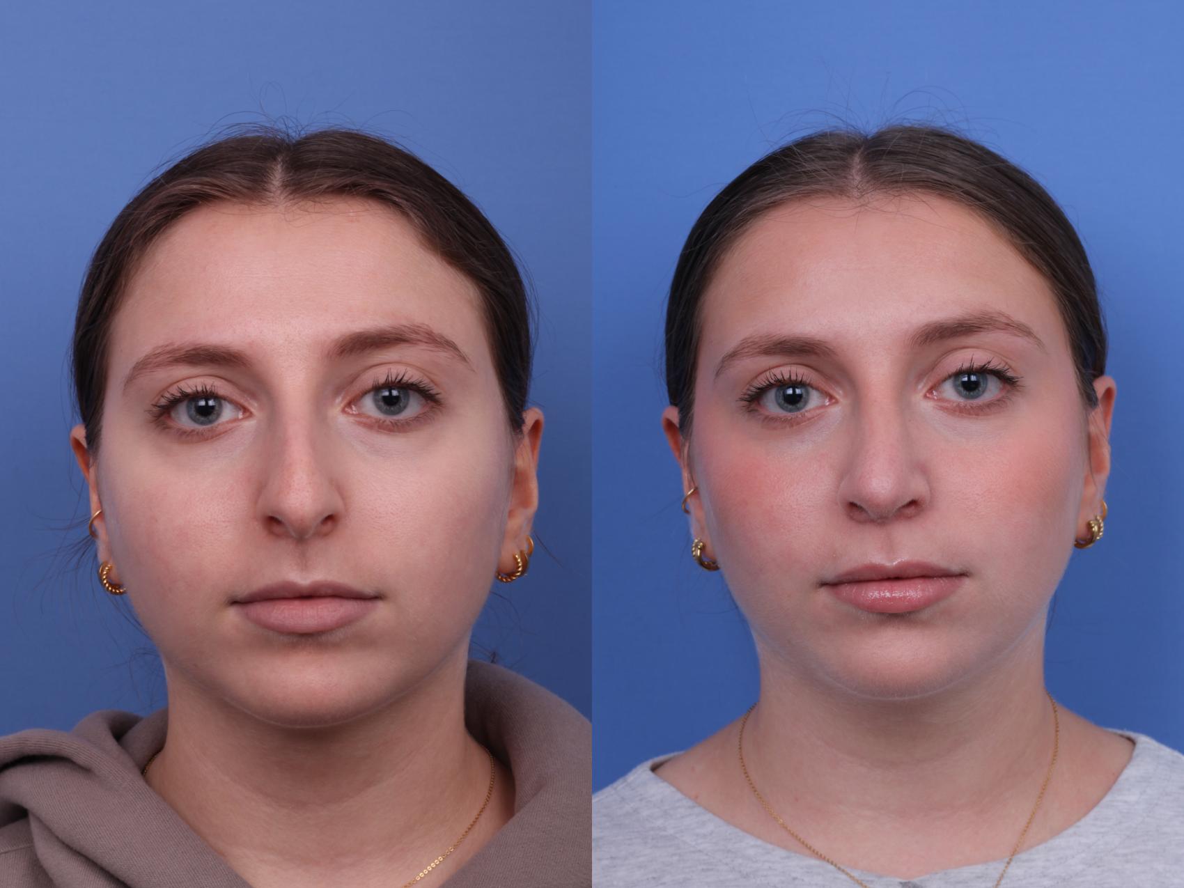 Before & After Rhinoplasty Case 606 Front View in Scottsdale, AZ