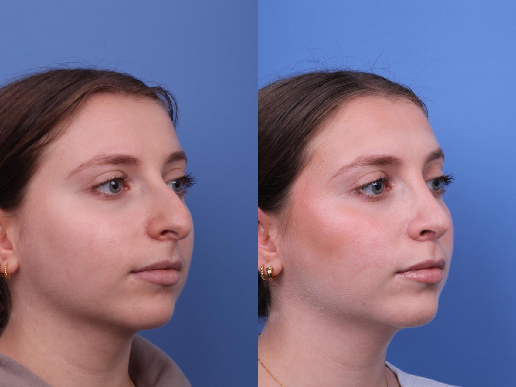 Before & After Rhinoplasty Case 606 Right Oblique View in Scottsdale, AZ