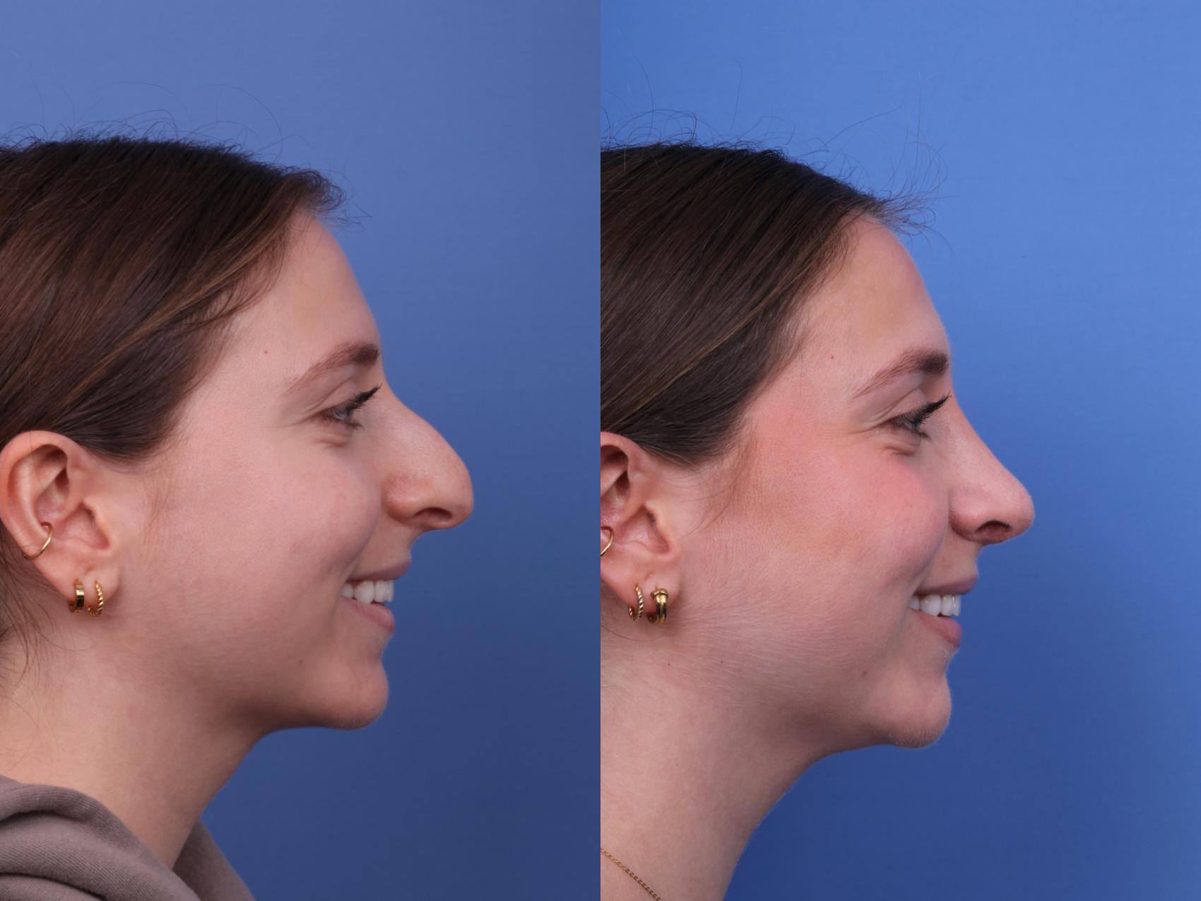 Before & After Rhinoplasty Case 606 Right Smile View in Scottsdale, AZ