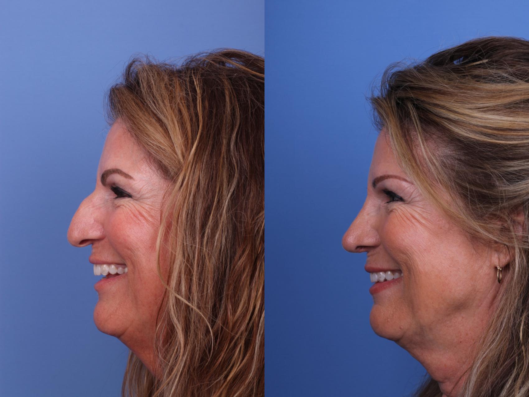 Before & After Rhinoplasty Case 607 Left Smile View in Scottsdale, AZ