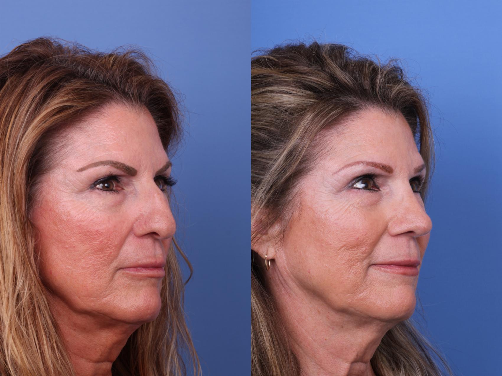 Before & After Rhinoplasty Case 607 Right Oblique View in Scottsdale, AZ
