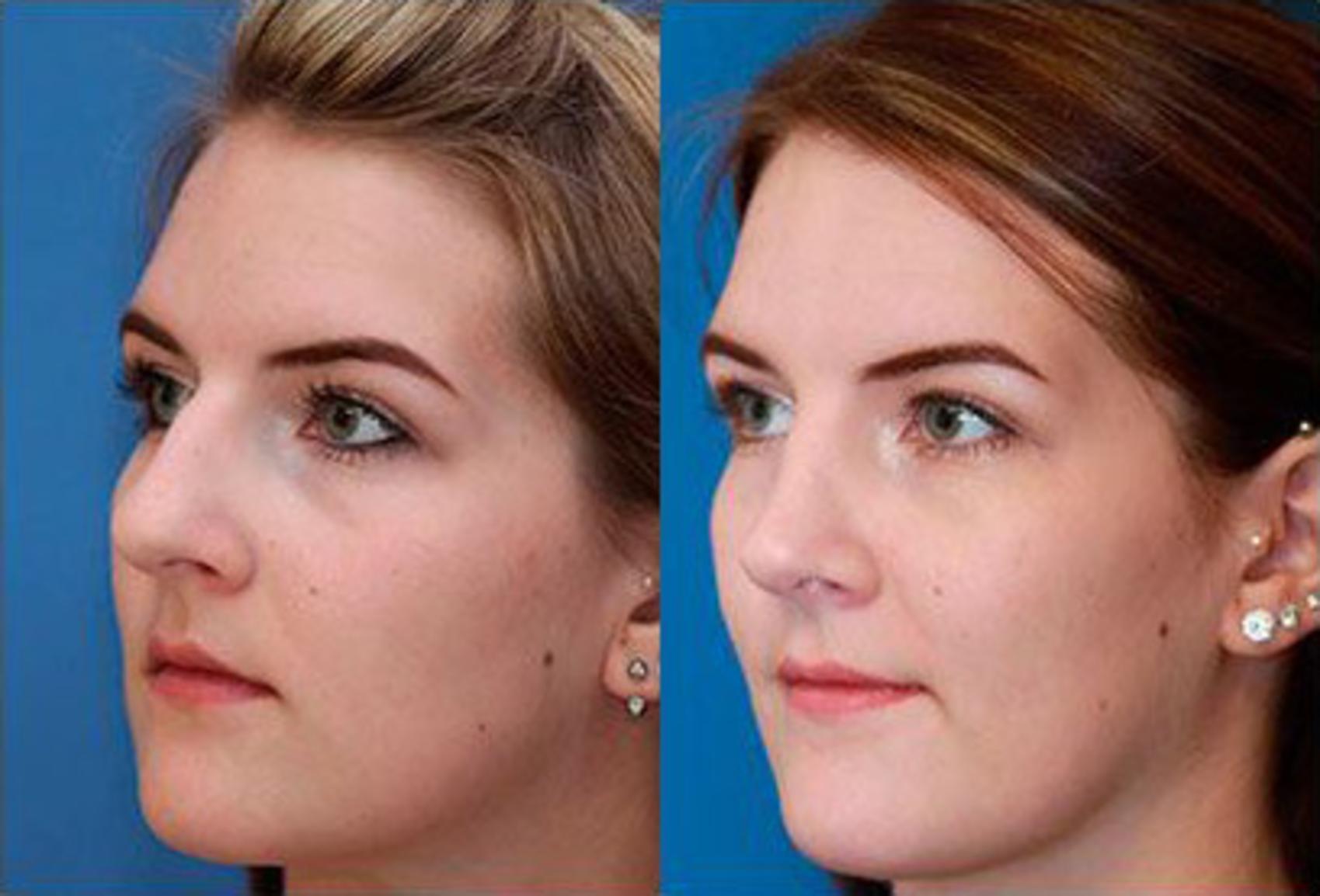 Before & After Rhinoplasty Case 61 View #2 View in Scottsdale, AZ