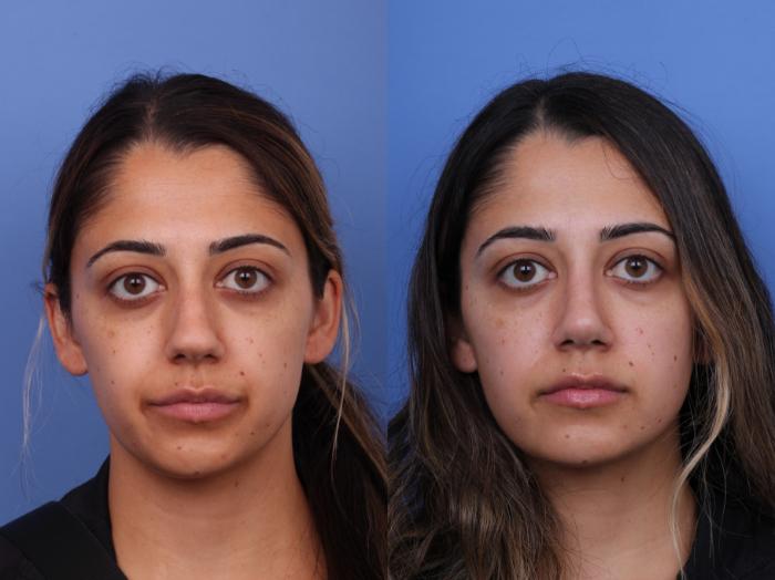Rhinoplasty Before & After Photo | Scottsdale & Phoenix, AZ | Hobgood Facial Plastic Surgery: Todd Hobgood, MD