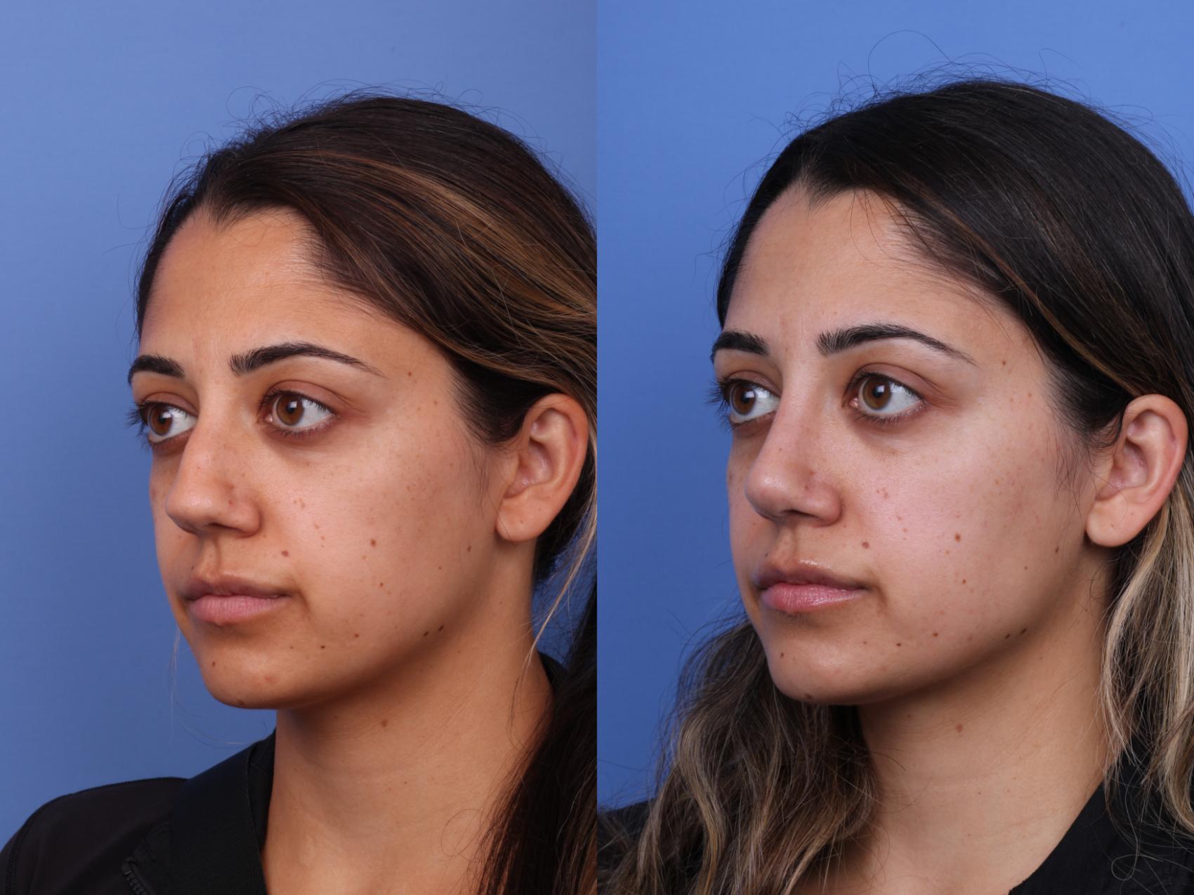 Before & After Ethnic Rhinoplasty Case 612 Left Oblique View in Scottsdale, AZ