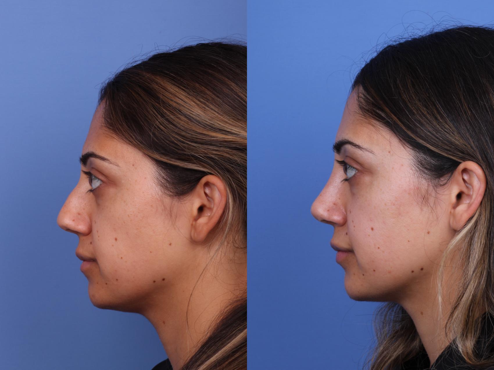 Before & After Ethnic Rhinoplasty Case 612 Left Side View in Scottsdale, AZ