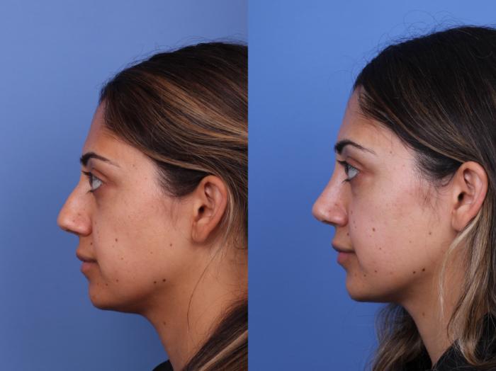 Rhinoplasty Before & After Photo | Scottsdale & Phoenix, AZ | Hobgood Facial Plastic Surgery: Todd Hobgood, MD