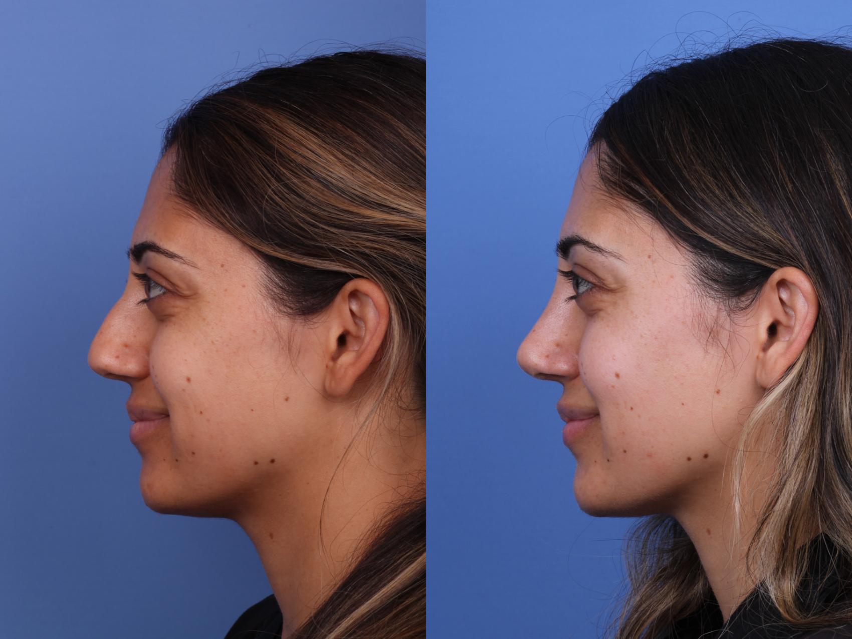 Before & After Ethnic Rhinoplasty Case 612 Left Smile View in Scottsdale, AZ