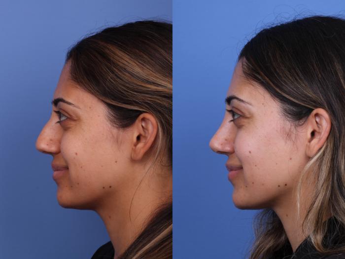 Rhinoplasty Before & After Photo | Scottsdale & Phoenix, AZ | Hobgood Facial Plastic Surgery: Todd Hobgood, MD