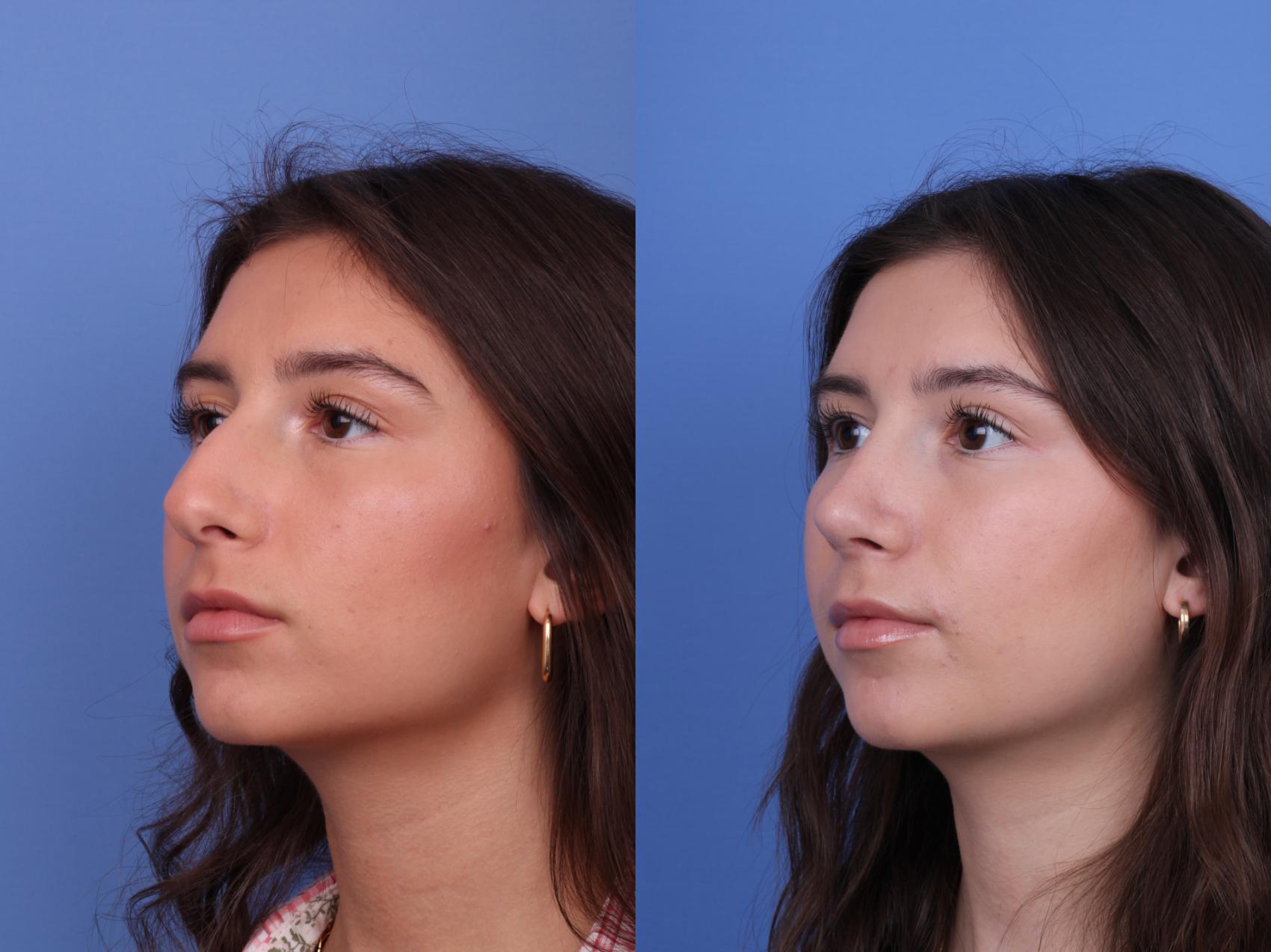 Before & After Rhinoplasty Case 613 Left Oblique View in Scottsdale, AZ
