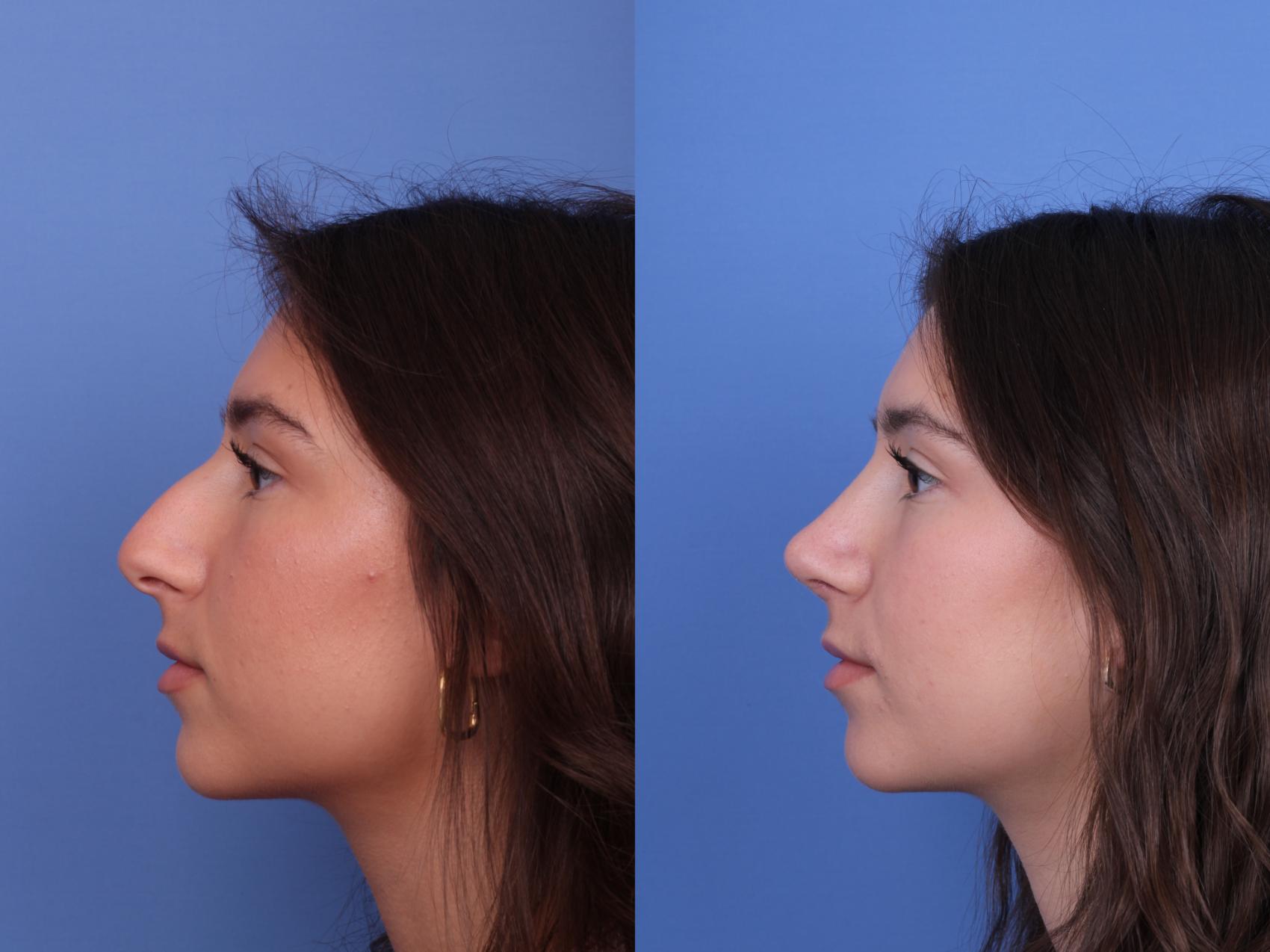 Before & After Rhinoplasty Case 613 Left Side View in Scottsdale, AZ