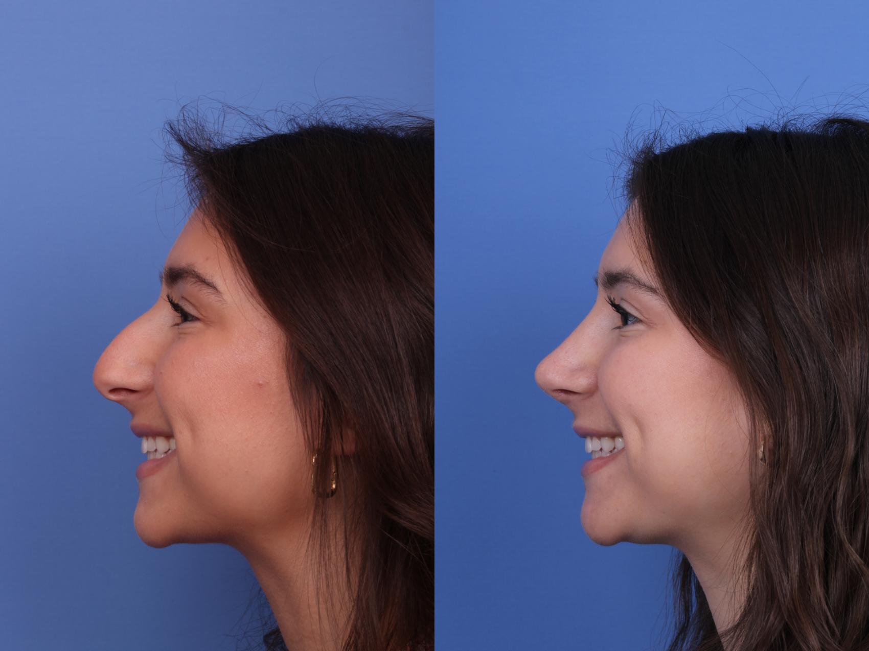 Before & After Rhinoplasty Case 613 Left Smile View in Scottsdale, AZ