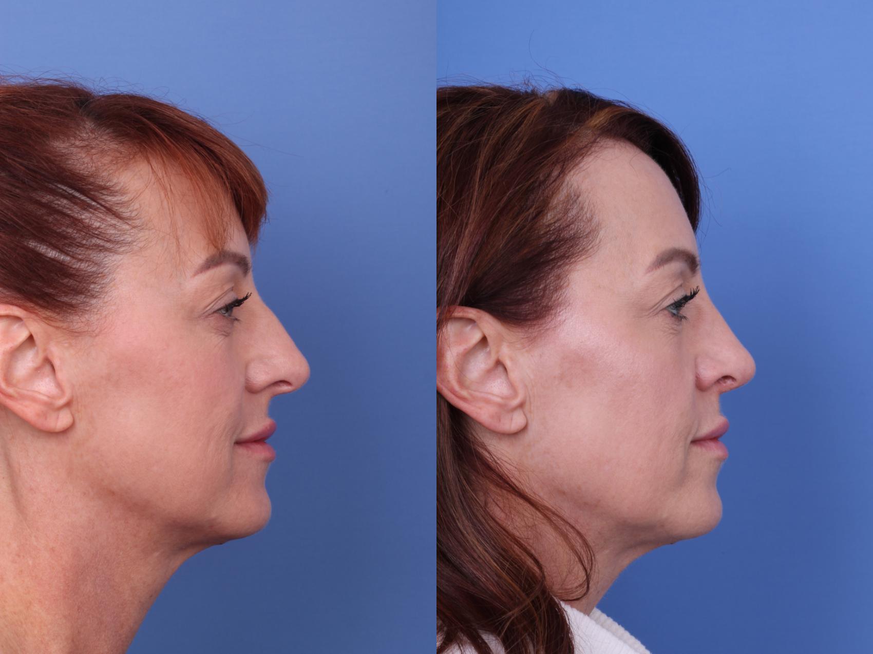 Before & After Rhinoplasty Case 617 Right Side View in Scottsdale, AZ