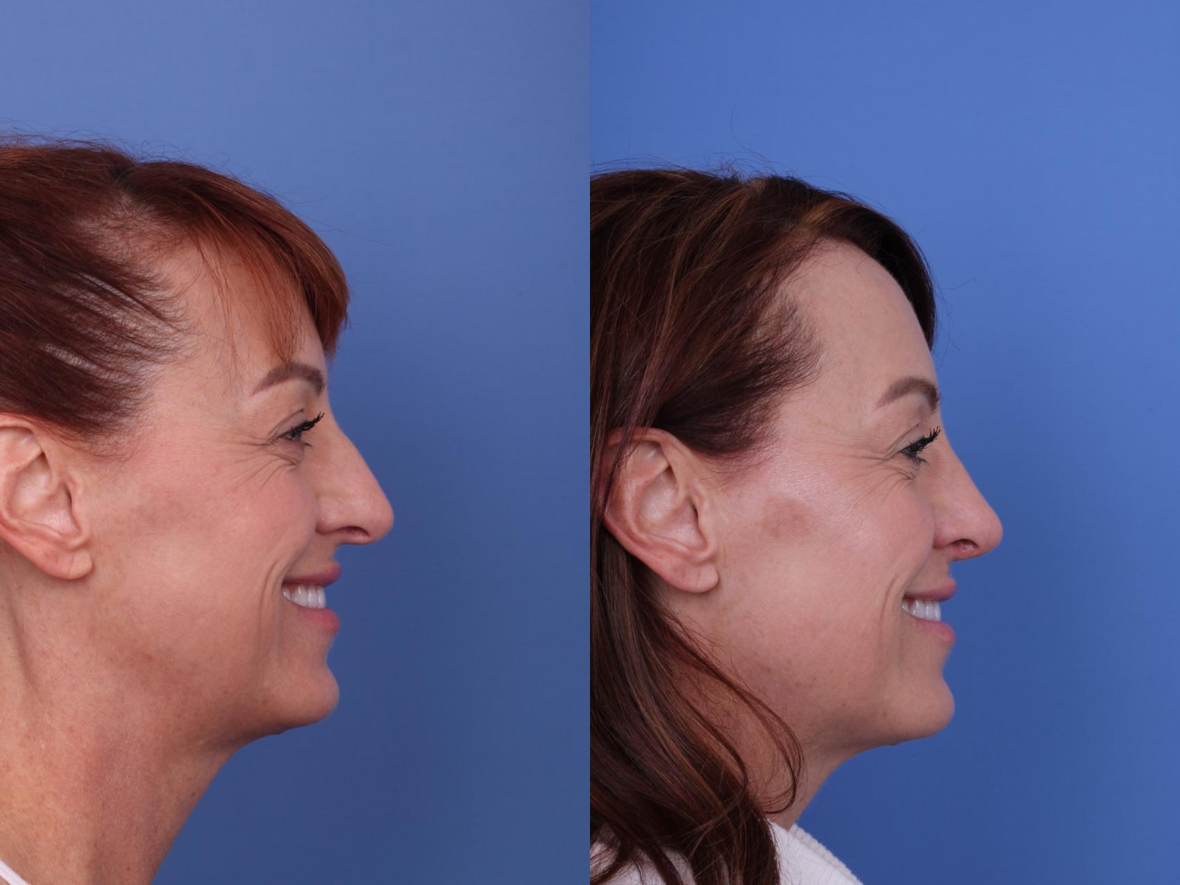 Before & After Rhinoplasty Case 617 Right Smile View in Scottsdale, AZ