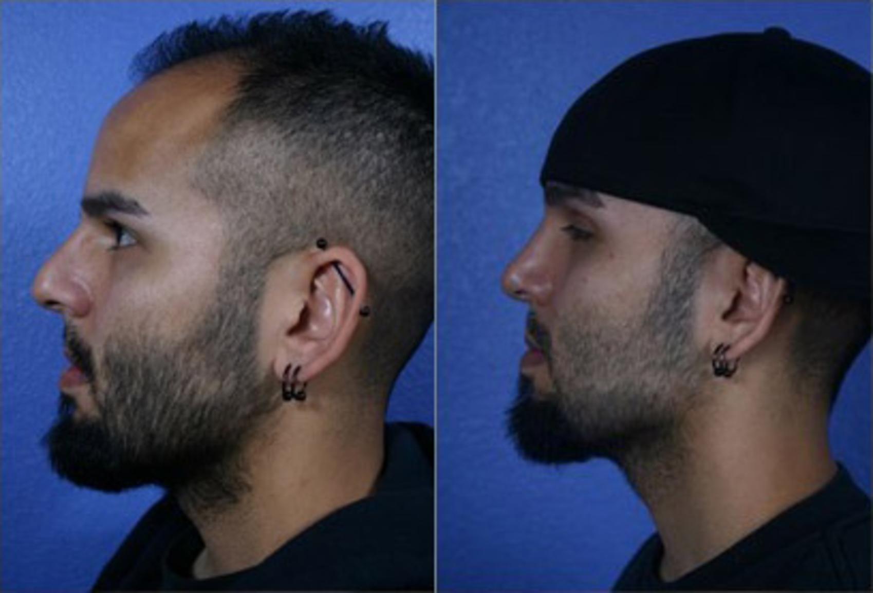 Before & After Rhinoplasty Case 62 View #2 View in Scottsdale, AZ