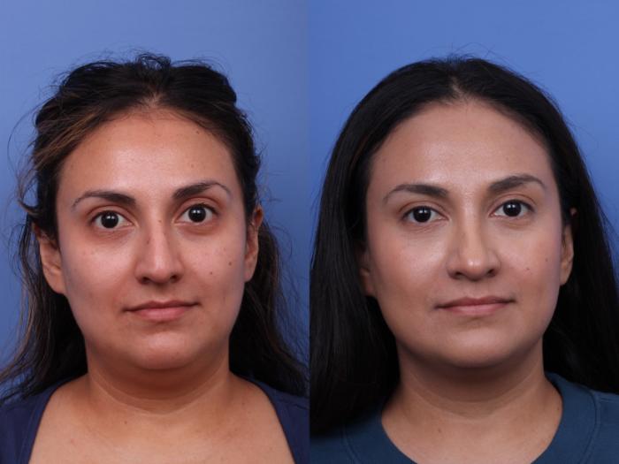 Rhinoplasty Before & After Photo | Scottsdale & Phoenix, AZ | Hobgood Facial Plastic Surgery: Todd Hobgood, MD