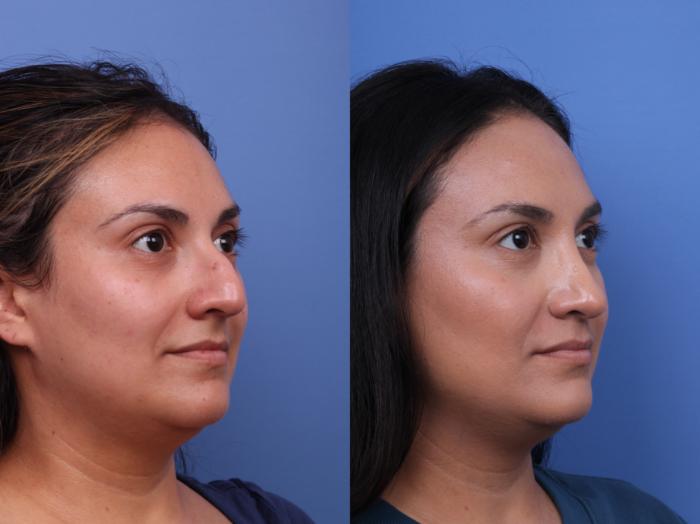 Rhinoplasty Before & After Photo | Scottsdale & Phoenix, AZ | Hobgood Facial Plastic Surgery: Todd Hobgood, MD