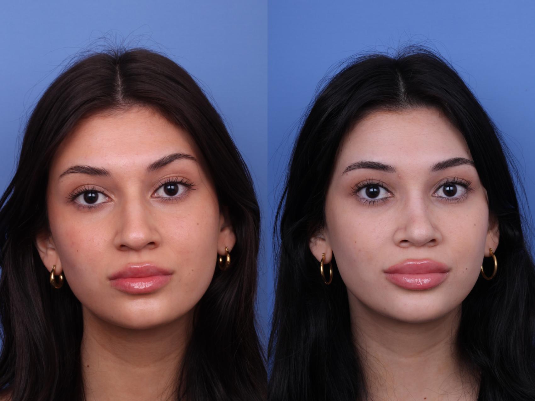 Before & After Rhinoplasty Case 622 Front View in Scottsdale, AZ