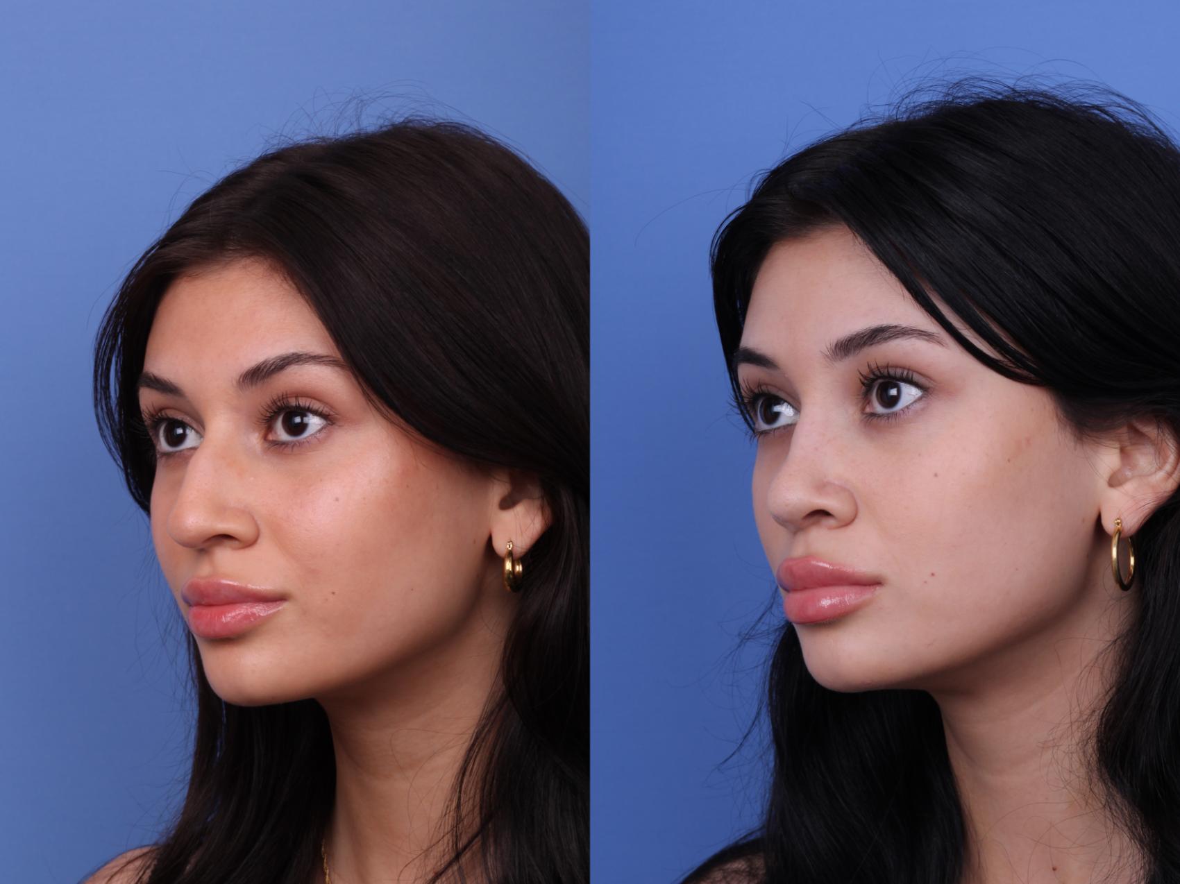 Before & After Rhinoplasty Case 622 Left Oblique View in Scottsdale, AZ
