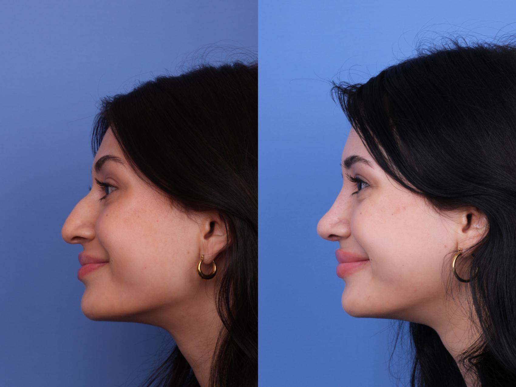 Before & After Rhinoplasty Case 622 Left Smile View in Scottsdale, AZ