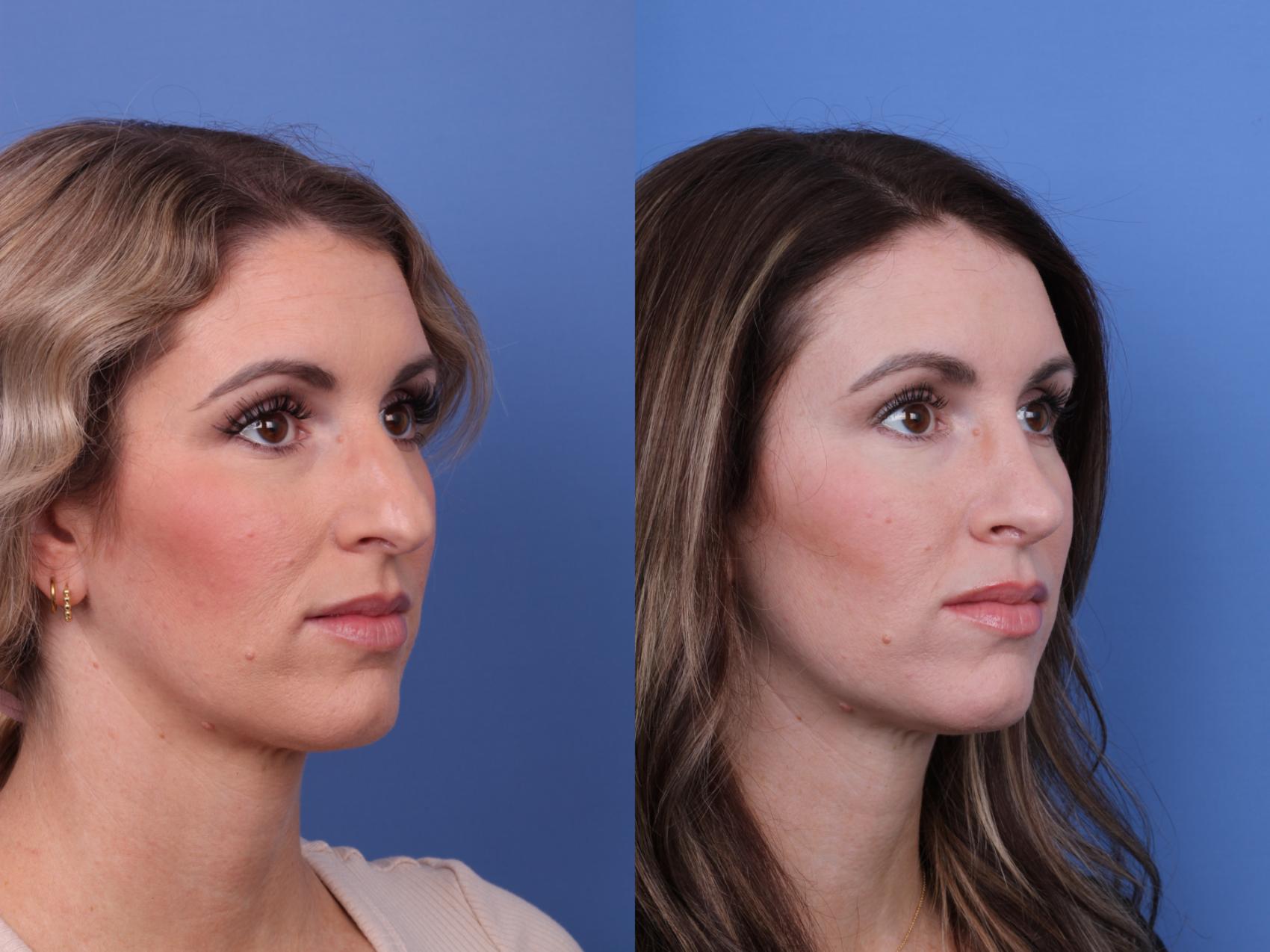 Before & After Rhinoplasty Case 624 Right Oblique View in Scottsdale, AZ