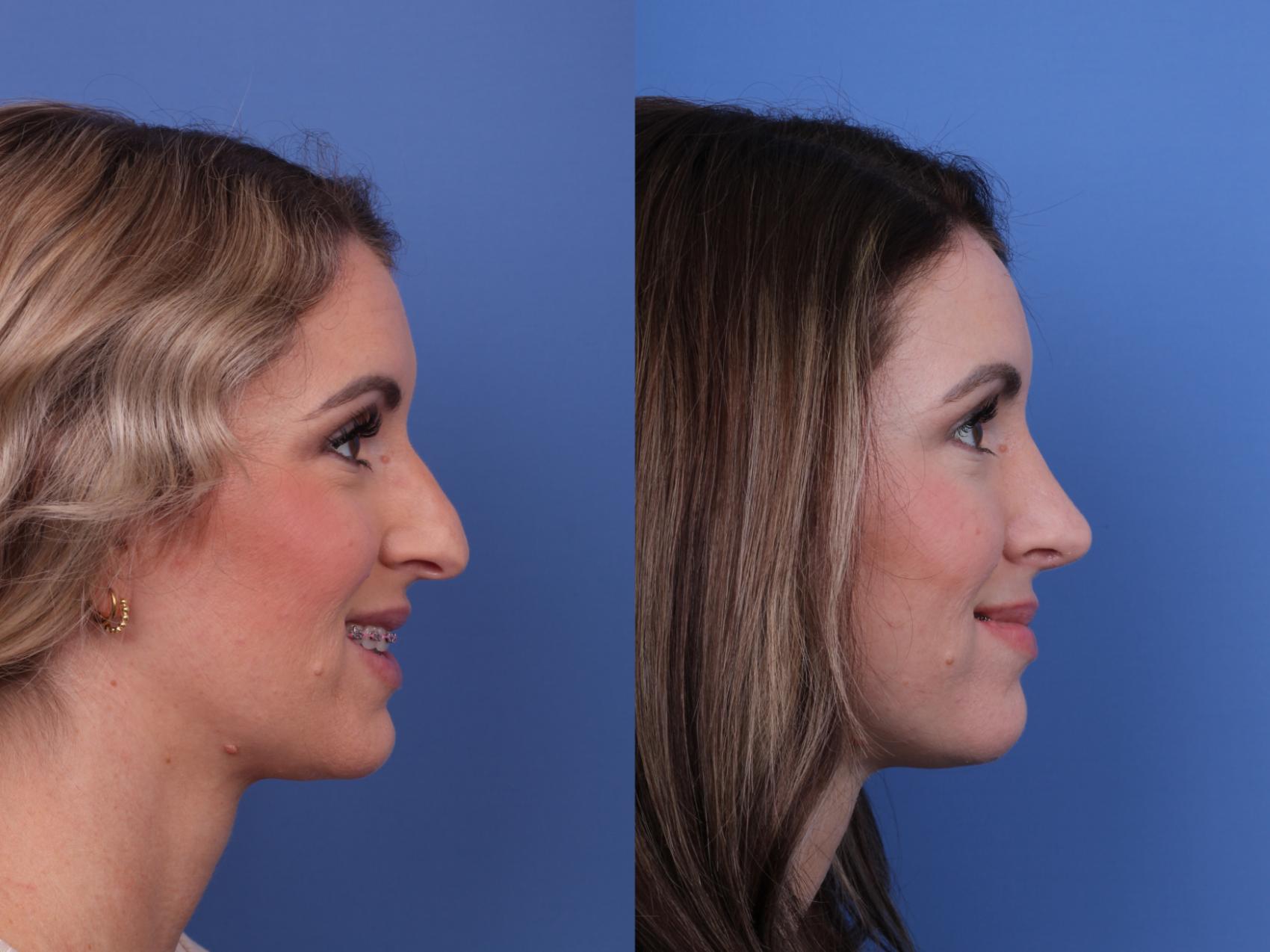 Before & After Rhinoplasty Case 624 Right Smile View in Scottsdale, AZ