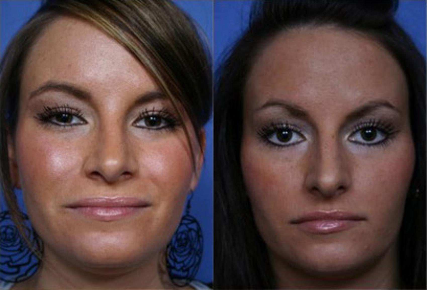 Before & After Rhinoplasty Case 63 View #2 View in Scottsdale, AZ