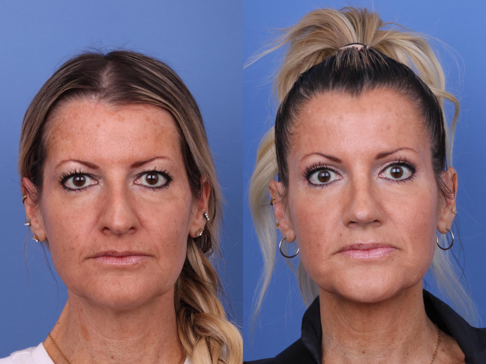 Before & After Rhinoplasty Case 634 Front View in Scottsdale, AZ