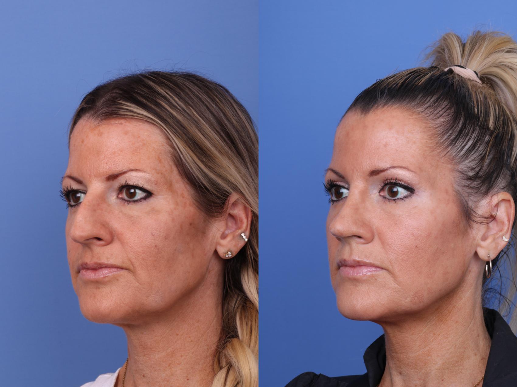 Before & After Rhinoplasty Case 634 Left Oblique View in Scottsdale, AZ
