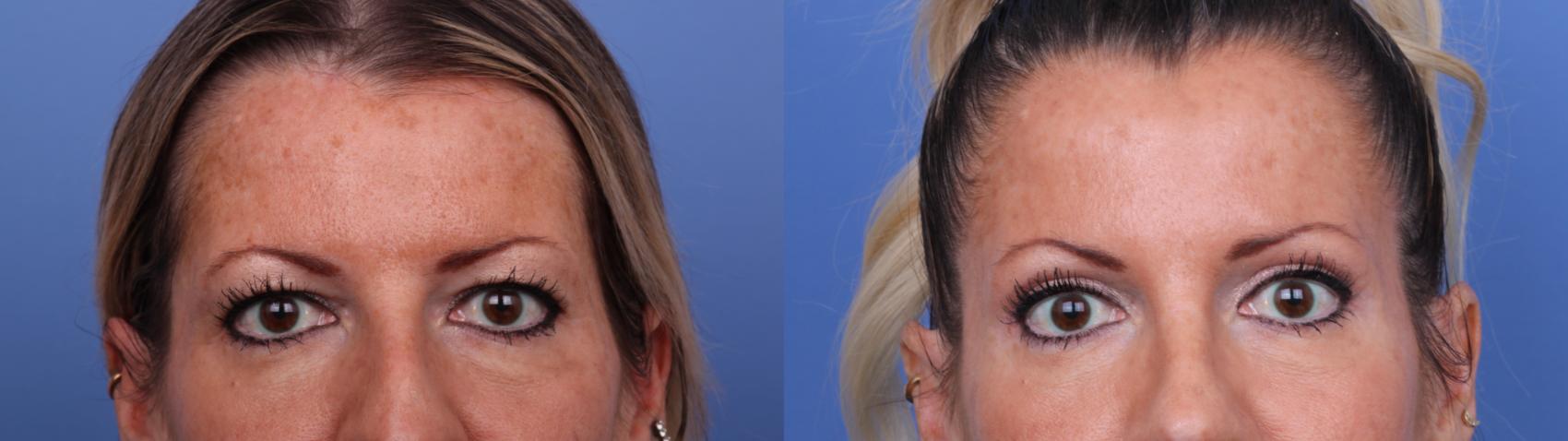 Before & After Rhinoplasty Case 634 Zoom Bleph View in Scottsdale, AZ