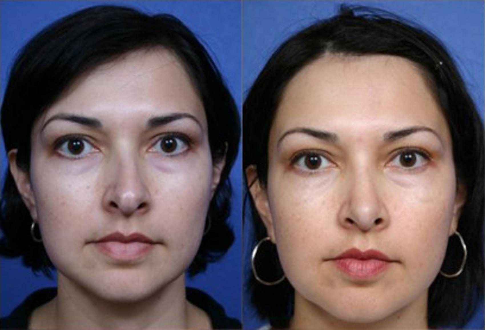 Before & After Rhinoplasty Case 64 View #2 View in Scottsdale, AZ