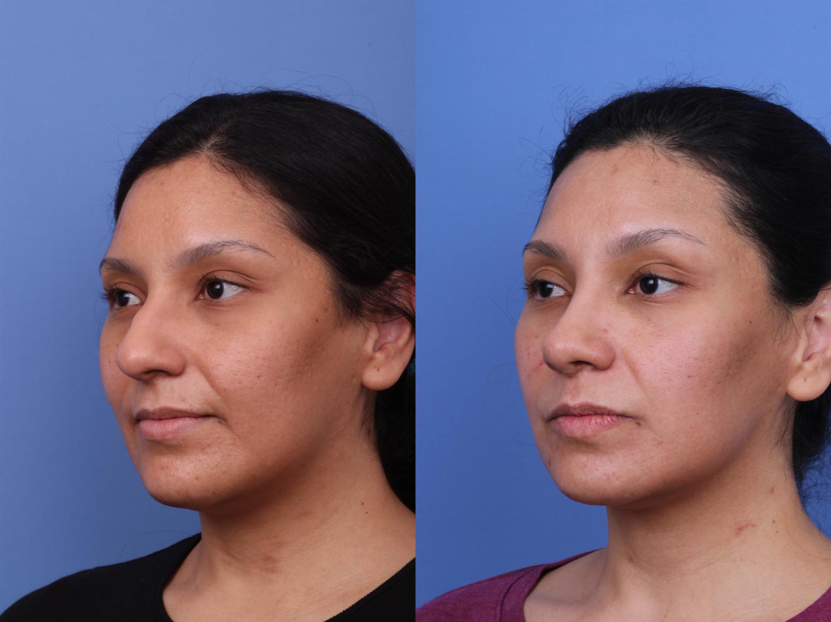 Before & After Rhinoplasty Case 640 Left Oblique View in Scottsdale, AZ