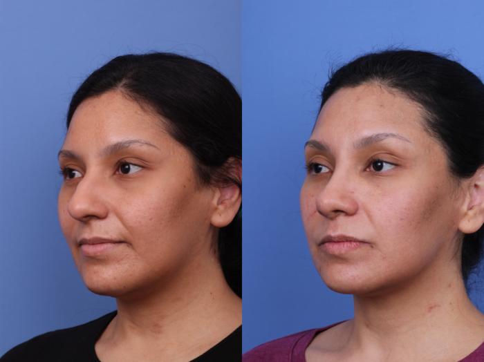 Rhinoplasty Before & After Photo | Scottsdale & Phoenix, AZ | Hobgood Facial Plastic Surgery: Todd Hobgood, MD