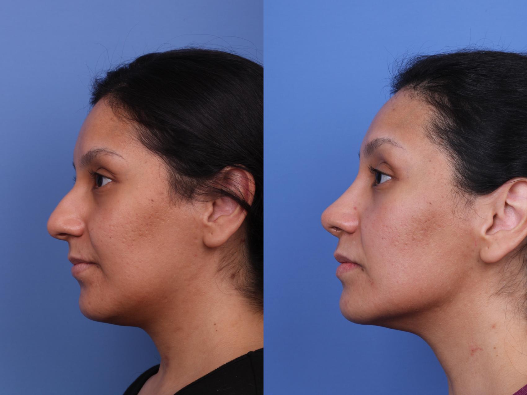 Before & After Rhinoplasty Case 640 Left Side View in Scottsdale, AZ